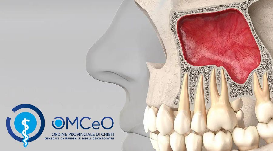 Clicca per accedere all'articolo " Tecniche rigenerative del seno mascellare: aspetti clinici e medico legali "